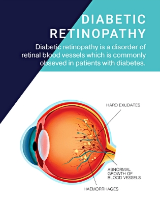 Diabetic Retinopathy Brochure